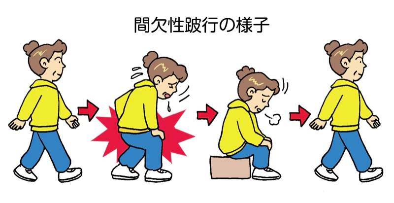 脊柱管狭窄症の主な症状